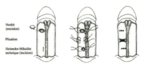 Nesbit operation