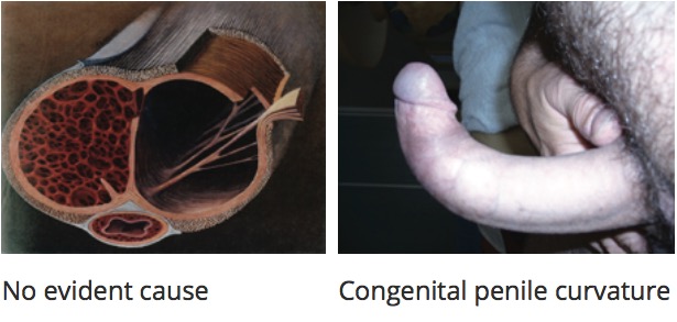 Penile curvature causes
